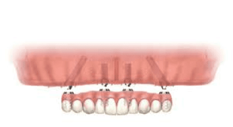 meest-gestelde-vragen-prothese-obv-implantaten